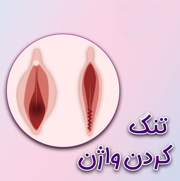  روش های تنگ کردن واژن