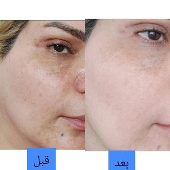 کرم ضد لک و روشن کننده گیاهی سی دام | آبرسان قوی پوست‌ های خشک، فاقد کورتون